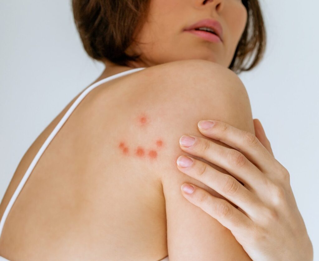 A,Woman,Scratches,Her,Shoulder,Bitten,By,A,Bedbug,On